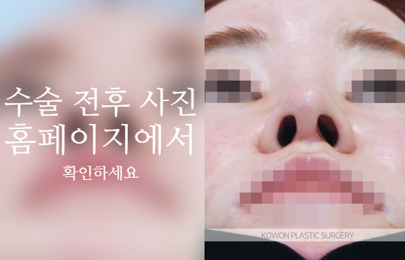 자가늑 코성형으로 코끝 처짐과 구조를 함께 고려해야 하는 이유 관련 이미지 6