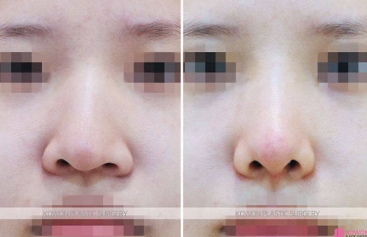 Q. Is drinking and smoking okay one month after nose surgery? A summary of nose-tip pulling symptoms and 기준 image 4