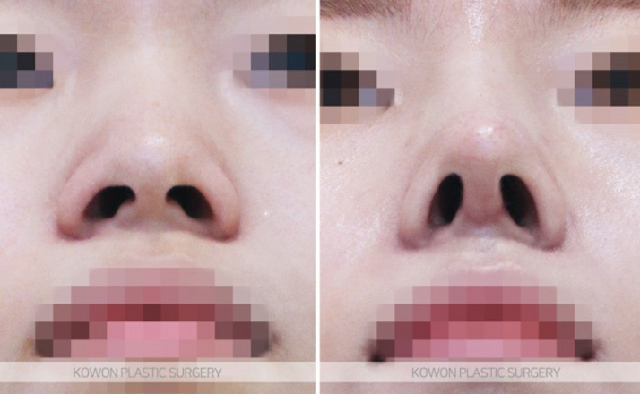 Q. How much swelling is there one month after nose surgery? Questions before rhinoplasty image 6