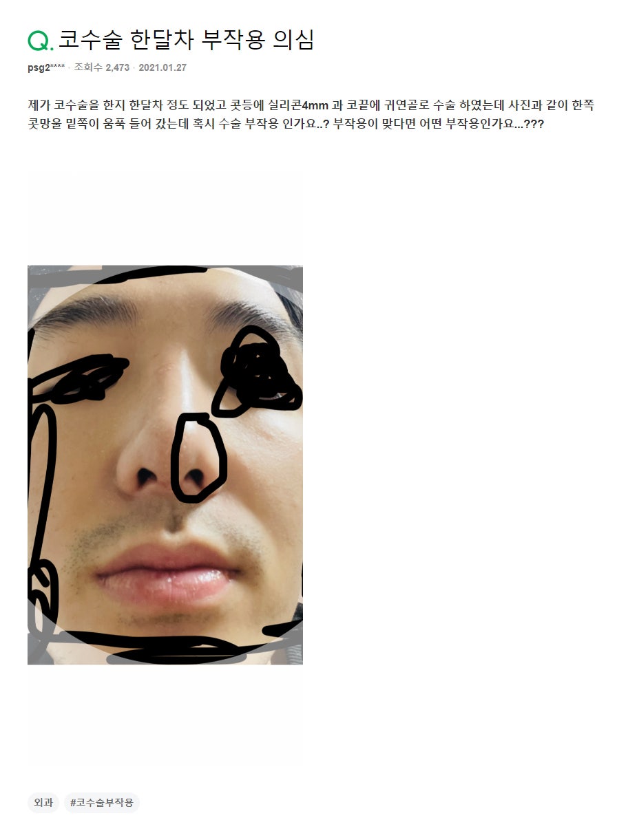 Q. Is this a side effect of nose surgery? I had surgery using ear cartilage for the nasal tip image 2