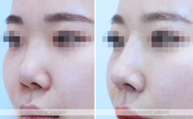 Q. Is a change in nose surgery silicone a case that requires revision surgery? image 4