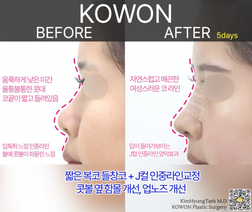 짧은코 성형 전후 얼마나 변할까? 짧은코 변화 과정과 회복까지 관련 이미지 4