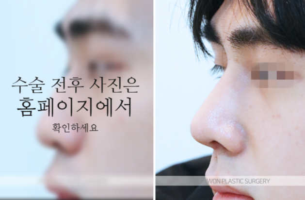 남자매부리코 교정, 비중격만곡증까지 함께 고려해야 하는 이유 관련 이미지 8
