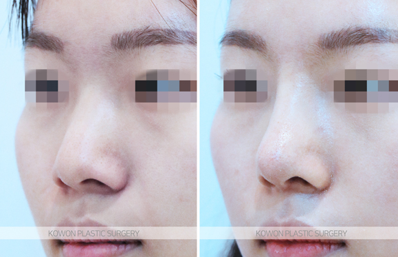 Q. I bumped my nose after nose surgery. It’s been over a year since the operation—will it be okay? image 5