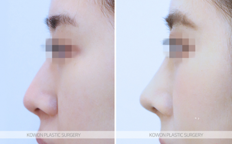 Low Nose Rhinoplasty: A Change to a More Three-Dimensional Impression, 3 Questions About Tip Cartilage Repositioning image 9