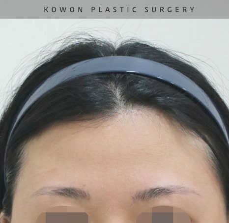 This is a review of nose surgery for a bulbous nose using donated rib cartilage at Kowon Plastic Surgery! image 17