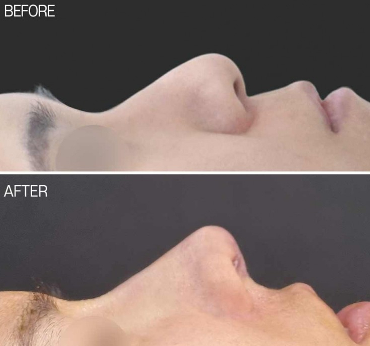 Will Autologous Rib Cartilage Nose Surgery Look Natural? A Process That Refined the Drooping Tip and Glabella Line image 2