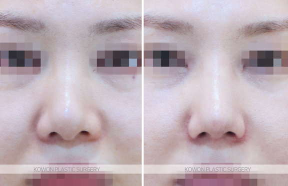 Looking at the Change Process Before and After Bulbous Nose Surgery and the Flow of Nasal Tip Structural Improvement image 8