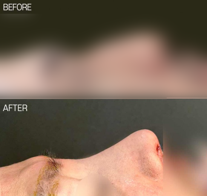 긴코성형, 매부리와 휜코까지 동시에 개선하는 코원성형외과의 노하우 관련 이미지 2