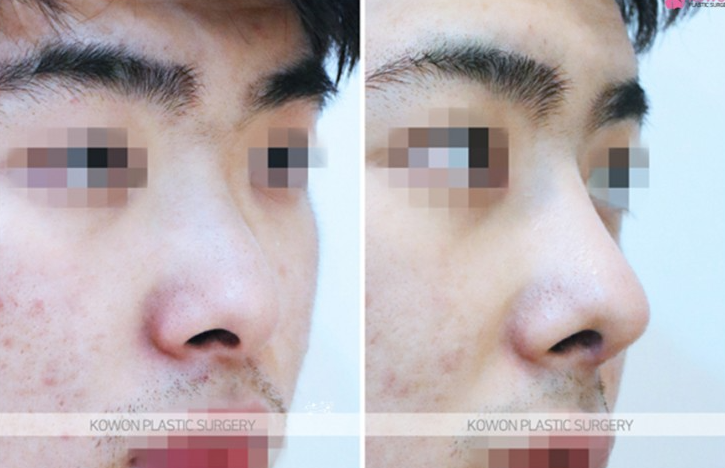 Q. Is it just a simple issue after male rhinoplasty in Gangnam? Resolving concerns about revisional surgery for nasal inflammation image 6