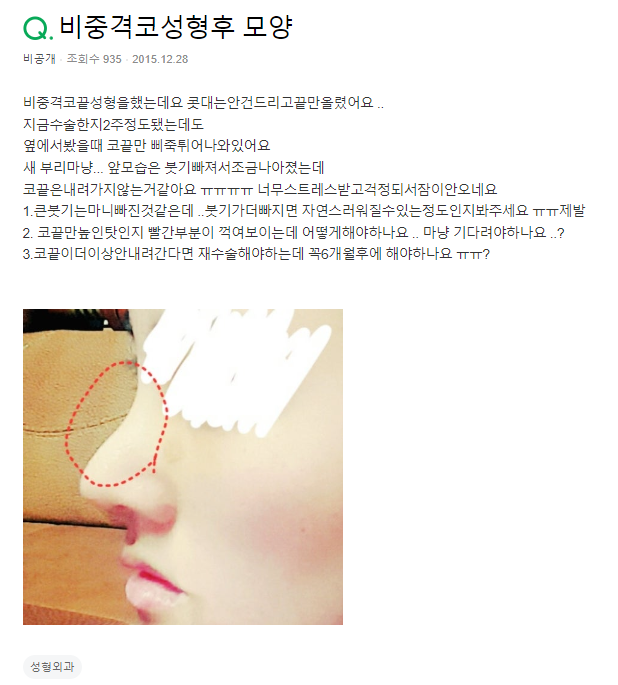 Q. Septal Tip Rhinoplasty, It Looks Unnatural... feat. Nose Swelling image 2