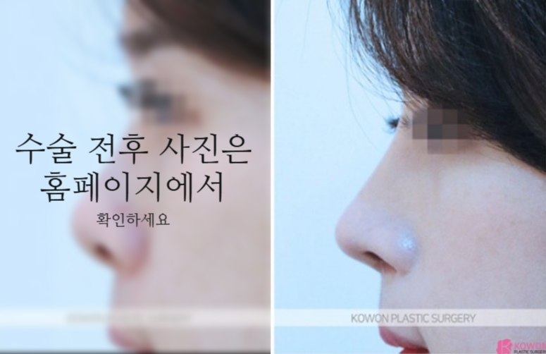 낮은코성형 코끝부터 비순각까지 함께 봐야 하는 3가지 이유 관련 이미지 6