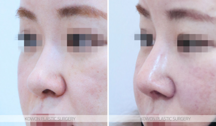 Q. Concerned about revision surgery for a long and wide nose: What is the key to natural-looking nose surgery results? image 8