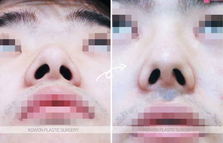Q. Is it just a simple issue after male rhinoplasty in Gangnam? Resolving concerns about revisional surgery for nasal inflammation image 8