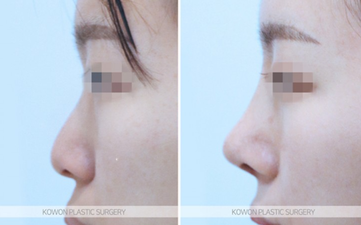 Q. How much swelling is there one month after nose surgery? Questions before rhinoplasty image 8