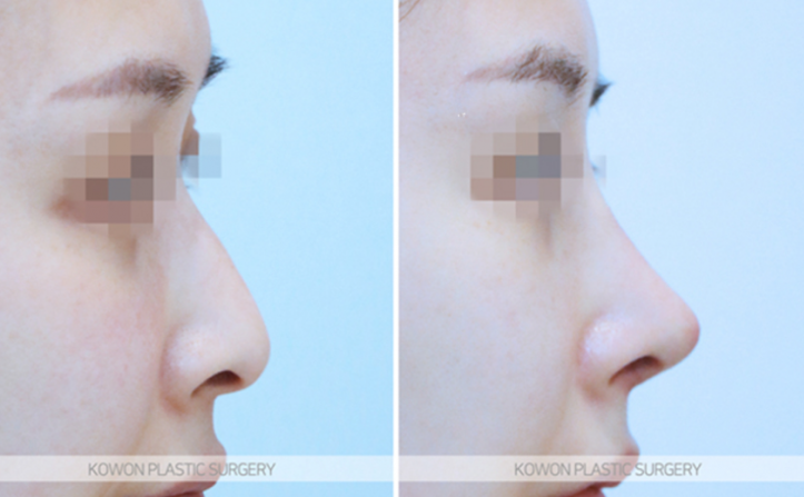 Q. I’m worried that a 4 mm silicone implant for a nose bridge augmentation will look obvious image 9