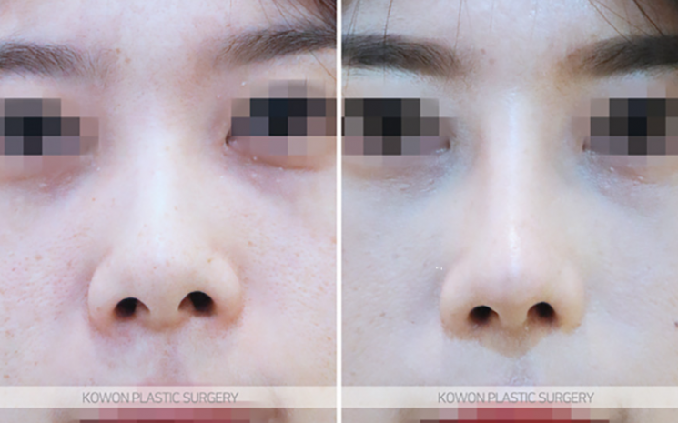 Q. Questions About Bulbous Nose Surgery and Post-Jaw Surgery Nose Surgery Answered image 8