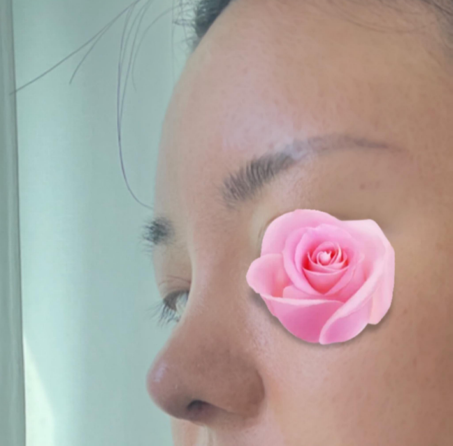 This is a review of nose surgery for a bulbous nose using donated rib cartilage at Kowon Plastic Surgery! image 7