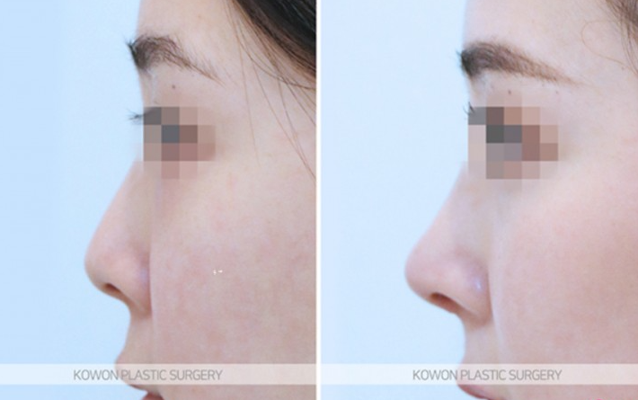 Q. I want to improve my nostrils without artificial implants in upturned nose surgery image 9