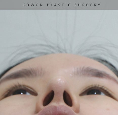 과도하게 화려한코, 귀연골에 비중격코수술로 자연스럽게 개선 됐어요! 관련 이미지 10