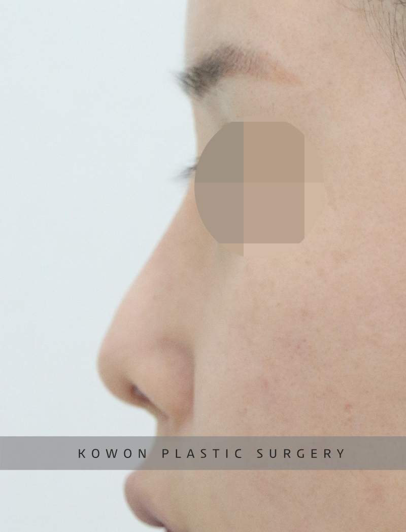 Revision Rhinoplasty Using Autologous Rib Cartilage, I Resolved My Concerns Through Surgery! image 8