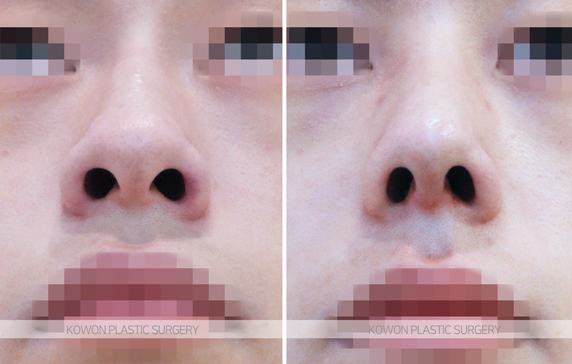 How Much Does a Man’s Hump Nose Surgery Change Your Appearance? Before-and-After Changes and Recovery Time Summary image 7