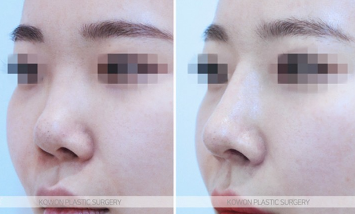Q. If You’re Considering Revision Rhinoplasty image 4