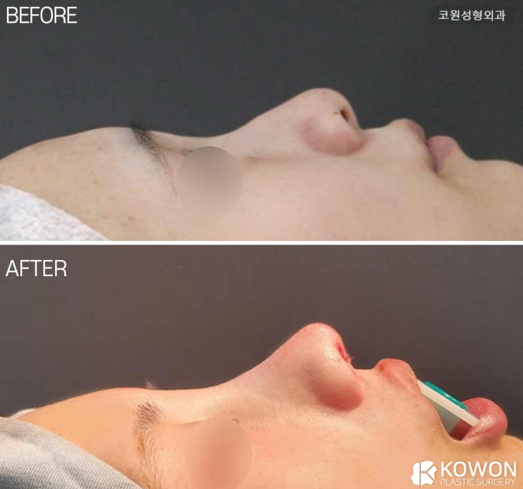 A Surgical Approach to a Drooping Tip and Long-Nose Appearance with Implant-Free Rhinoplasty image 2