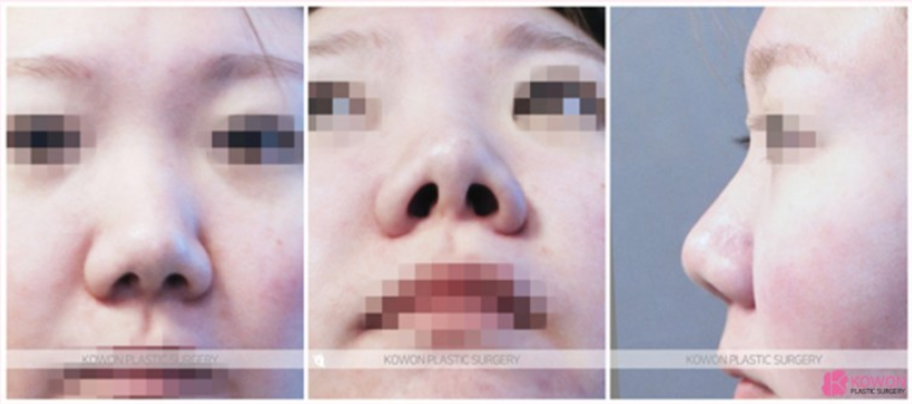작은코 성형, 짧은 코와 둥근 코끝을 자연스럽게 개선한 코원성형외과 사례 관련 이미지 3