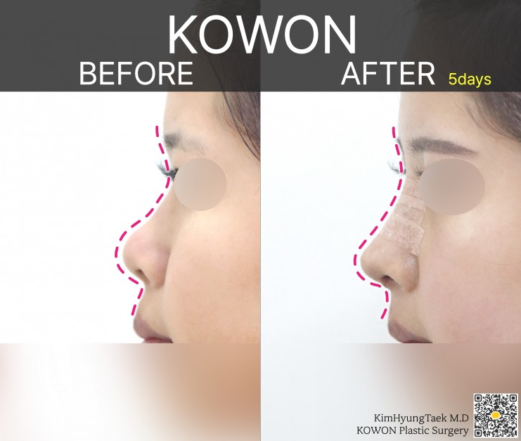 Q. My nose became a hooked nose after nose surgery.. What kind of revision surgery would be needed? image 5