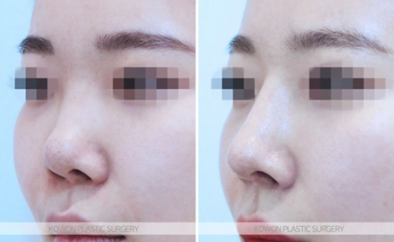 Will Autologous Rib Cartilage Nose Surgery Look Natural? A Process That Refined the Drooping Tip and Glabella Line image 4