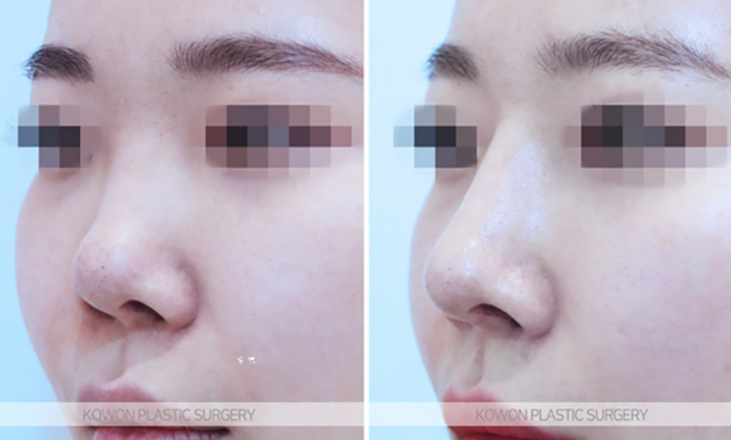 Q. Why Do the Nostrils Look Uneven After Revision Nose Surgery with Ear Cartilage? image 4