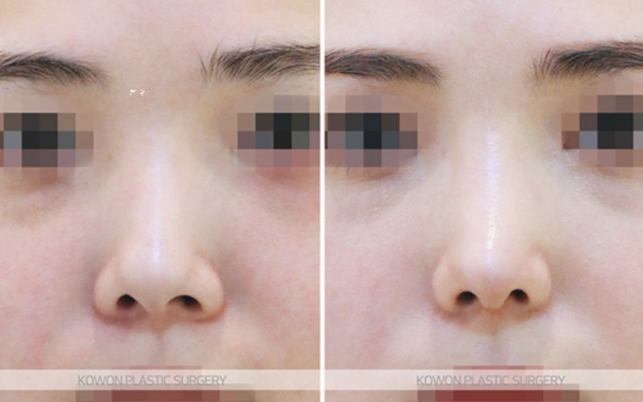 Q. I want to improve my nostrils without artificial implants in upturned nose surgery image 6