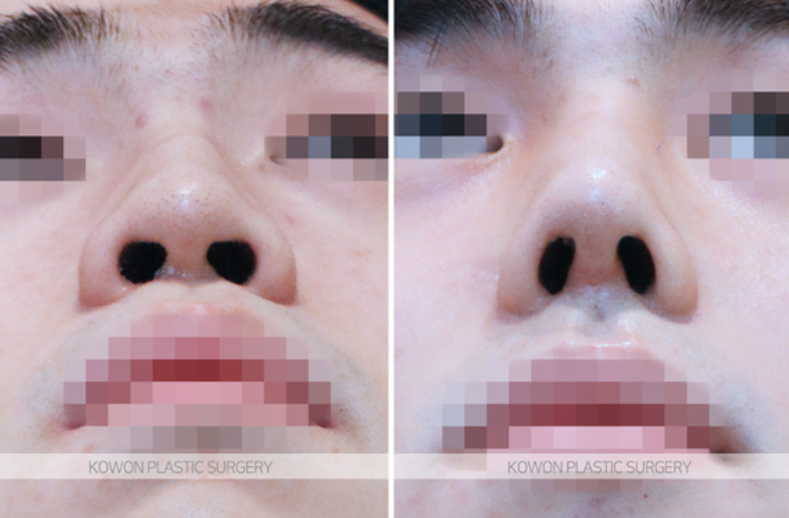Correcting a Hump Nose and Positive Changes in the Nose Tip Line Shown in Before-and-After Male Rhinoplasty Photos image 7