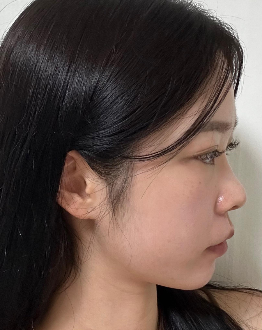 I successfully got the nose shape I wanted with 비순각 surgery and low-nose rhinoplasty! image 1