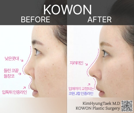코원성형외과 코재수술성형외과에서 자가늑코재수술로 원하는 코를 주셨어요! 관련 이미지 20