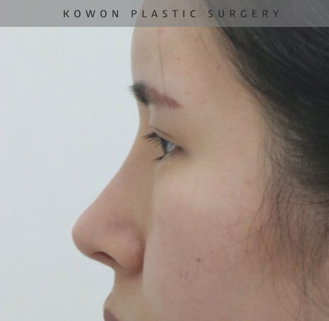 과도하게 화려한코, 귀연골에 비중격코수술로 자연스럽게 개선 됐어요! 관련 이미지 12