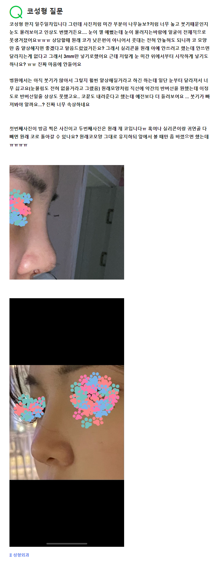 Q. One week after rhinoplasty at a plastic surgery clinic, I’m so upset because my eyes look sunken in. image 2
