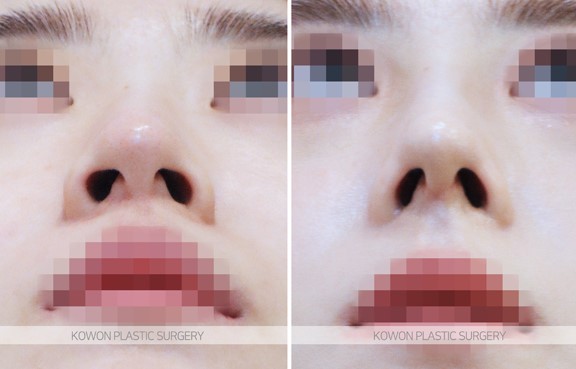 Q. In a deviated nose surgery, will failing to correct the crooked nasal bone cause problems with nose growth? image 3
