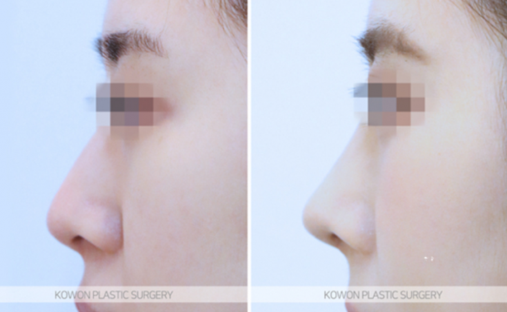 Q. Worried About Crooked Nose Surgery, What Nose Surgery Direction Should Be Considered Before Double Jaw Surgery image 6