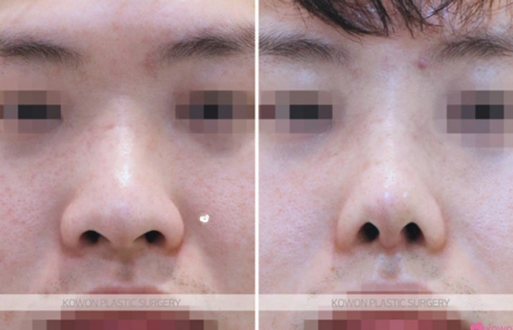 Q. I’m interested in male rhinoplasty and eye surgery—where is a good clinic for male nose surgery? image 9