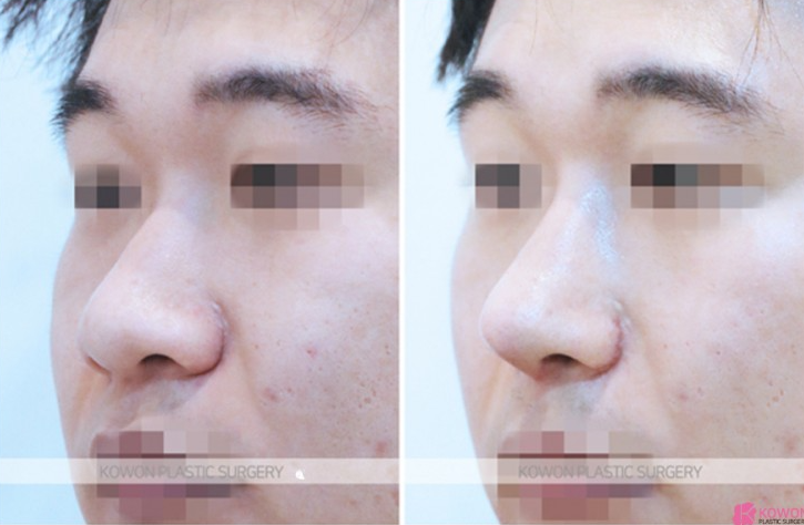Q. Cartilage Pain After Nose Surgery: Is It a Side Effect of Male Rhinoplasty? Causes and How to Handle It image 9