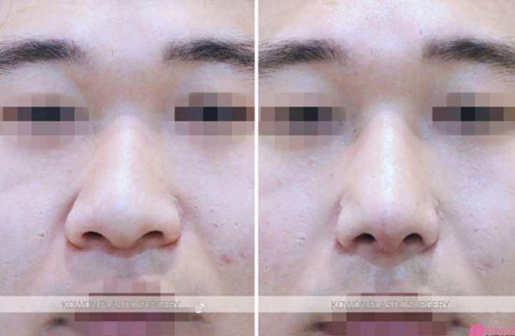 Q. Cartilage Pain After Nose Surgery: Is It a Side Effect of Male Rhinoplasty? Causes and How to Handle It image 8