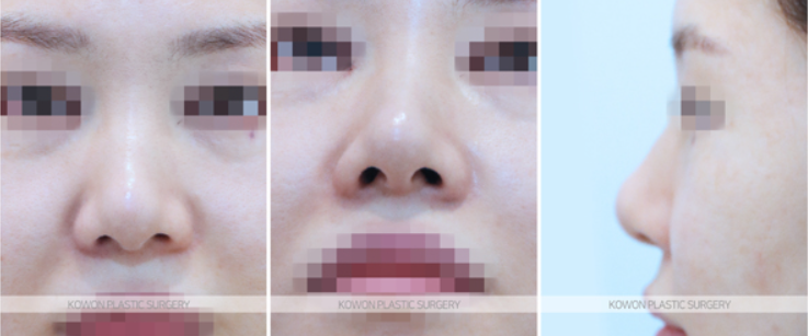Q. 고민 about alar base surgery: do the nostrils need shape correction? image 4