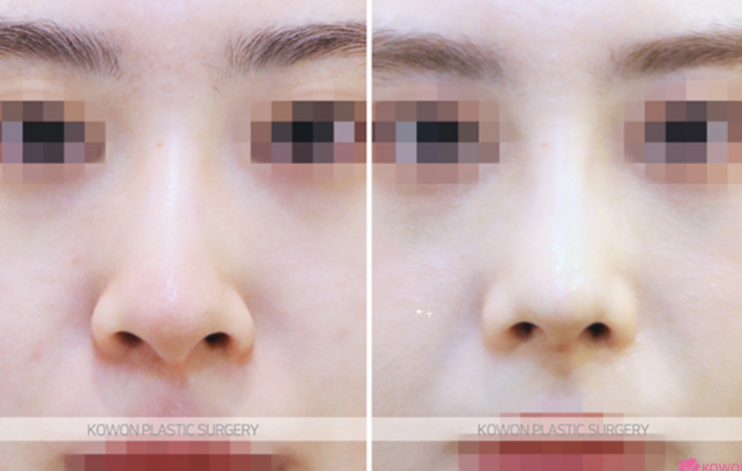 Q. Which is the right choice: nasal osteotomy or tip elevation in nose surgery? image 9