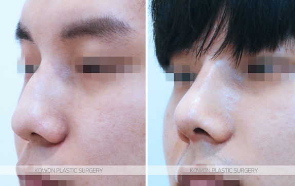 How Long Does Nose Surgery Swelling Last? A Summary of Immediate Changes and the Recovery Process image 7