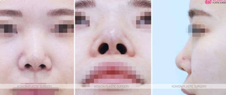 Q. I had nose surgery. Is this a complication? I’m wondering if I need revision rhinoplasty image 5