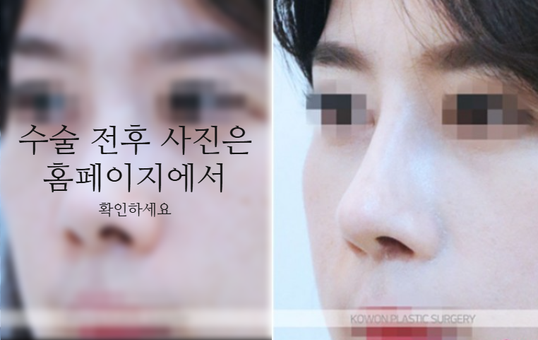 낮은코성형 코끝부터 비순각까지 함께 봐야 하는 3가지 이유 관련 이미지 7