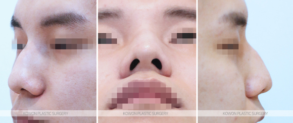 How Long Does Nose Surgery Swelling Last? A Summary of Immediate Changes and the Recovery Process image 4