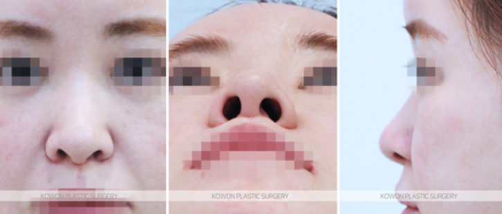 Q. I heard that 10 years after nose surgery, revision surgery is mandatory. Is that true? image 3